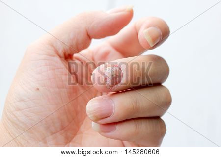 Fungus Infection On Nails Hand, Finger With Onychomycosis. - Soft Focus