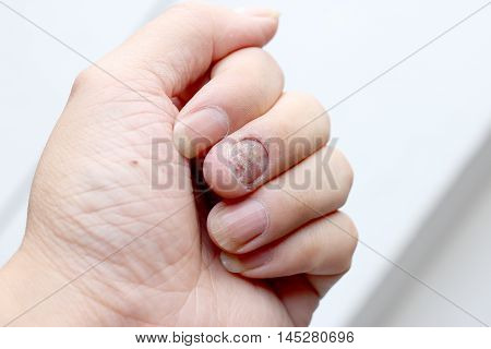Fungus Infection On Nails Hand, Finger With Onychomycosis. - Soft Focus