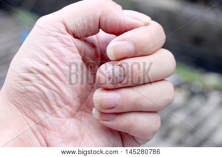 Fungus Infection On Nails Hand, Finger With Onychomycosis. - Soft Focus