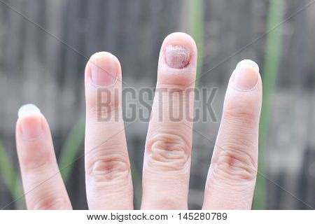 Fungus Infection On Nails Hand, Finger With Onychomycosis. - Soft Focus