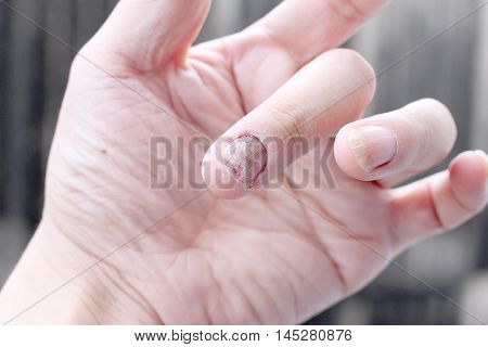 Fungus Infection On Nails Hand, Finger With Onychomycosis. - Soft Focus