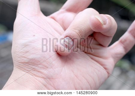 Fungus Infection On Nails Hand, Finger With Onychomycosis. - Soft Focus