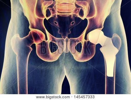 Hip replacement. Xray. Human anatomy. 3D illustration