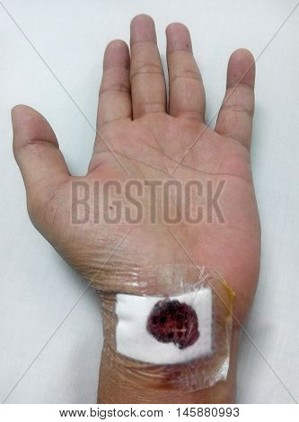 MALACCA, MALAYSIA -MARCH 09, 2016: Left wrist injury and was treated. There were traces of blood on the bandage