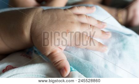 Baby Have Mosquito Bite On Skin And Have Mark