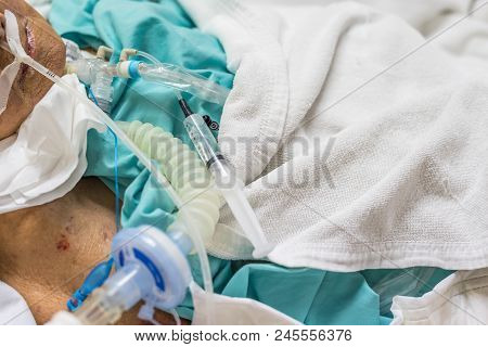 Patient Do Tracheostomy And Ventilator In Hospital