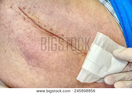 Replacing Of The Devastated Hip Joint For The Hip Endoprosthesis. Selective Focus Of Human Leg With 