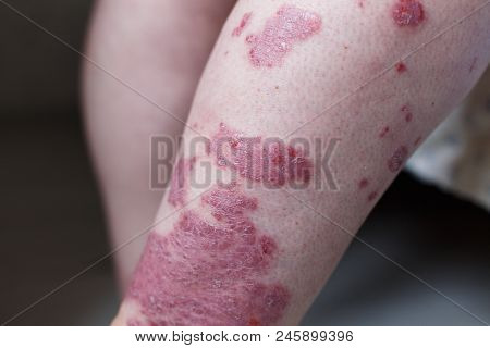 Allergic Rash Dermatitis Eczema Skin On Leg Of Patient. Psoriasis And Eczema Skin With Big Red Spots