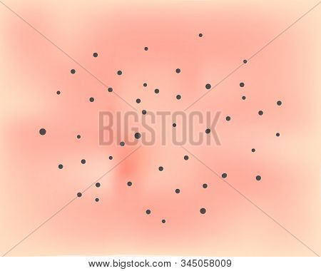 Open Comedos. Skin With Acne Background. Black Spots. Acne On The Skin Texture. Infographics. Illust