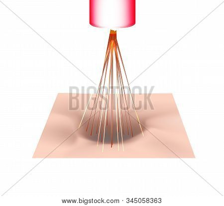 Acne Scars. Laser Scar Atrophic Treatment. The Anatomical Structure Of The Skin With Acne. Illustrat