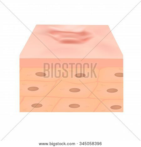 Scars Hypertrophic. The Anatomical Structure Of The Skin Scar. Illustration On Isolated Background.
