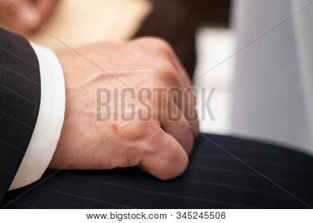 Bussiness Man Showing A Little Lesion On His Hand, Accident Wounded Male Hand, Wound Marks On The Ri