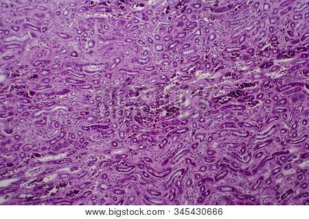 Diffuse Proliferative Glomerulonephritis, Dpgn, Light Micrograph, Photo Under Microscope
