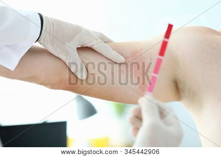 Male Doctor Hold Allergy Express Test In Hand Closeup. Choosing Skin Treatment Method Concept