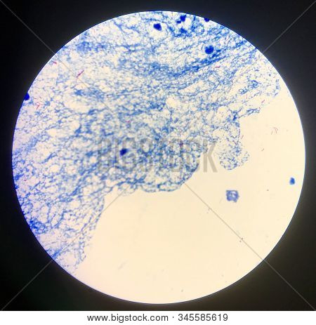 Mycobacterium Tuberculosis In Sputum  Positive 3+.