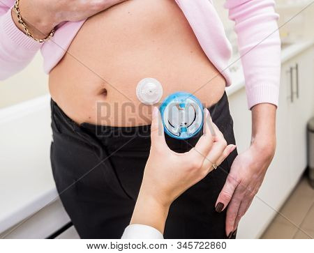 Doctor Install Patient Insulin Catheter For A Simple Injection Of Insulin. Diabetes Concept