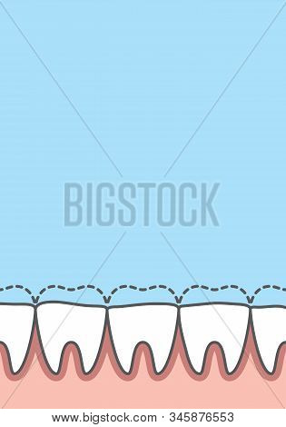 Blank Banner Attrition (bruxism) Teeth Illustration Vector On Blue Background. Dental Concept.