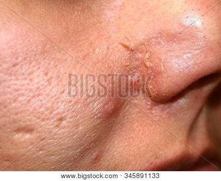 Inflamed Skin On The Face. Acne. Pimples On The Skin. Scars And Peeling.