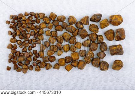 Cholelithiasis, Gallbladder Stones Laid Out In Size After A Successful Cholecystectomy