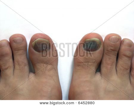 Toe_bruise_