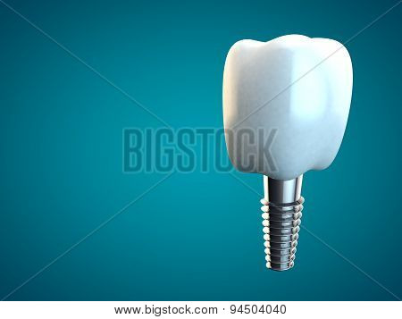 Tooth Molar Implant Dental Hygiene Dentist 3D Blue