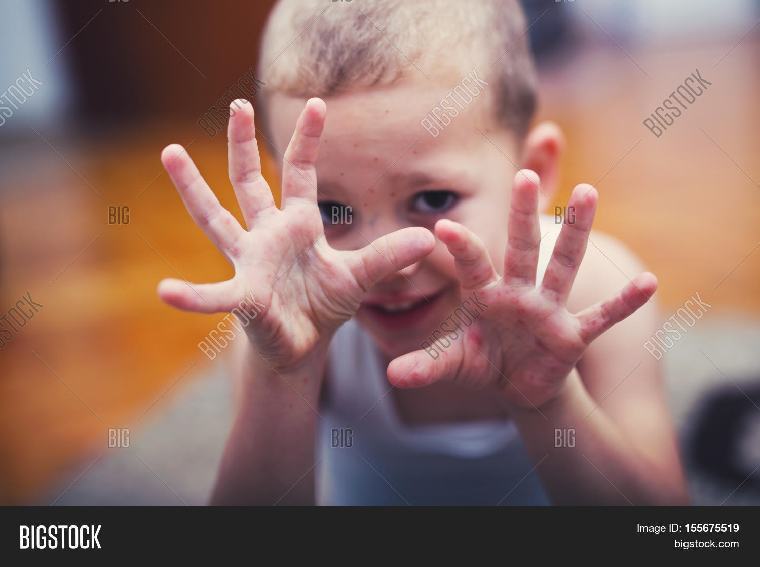 Вирус Коксаки Фото Детей – Telegraph