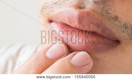 Closeup of lips man problem health care Herpes simplex