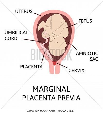 Different Placental Locations During Pregnancy. Major And Normal Placenta Previa, Total And Partial.