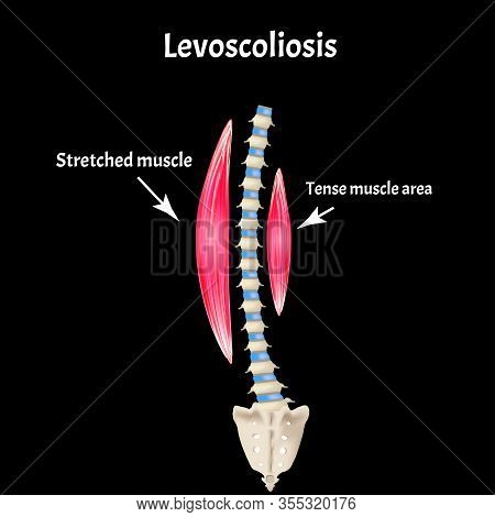 Left-sided Scoliosis. Levoscoliosis. Muscles And Spine. Spinal Curvature In Scoliosis. Infographics.