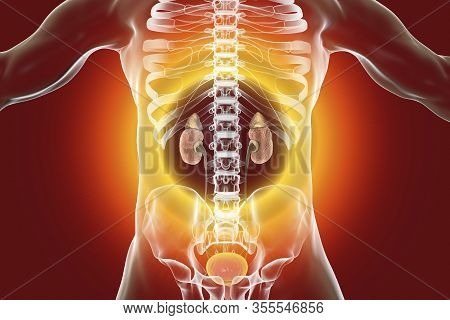 Chronic Glomerulonephritis, Gross Pathology, Scientifically Accurate 3d Illustration Showing Pale Co