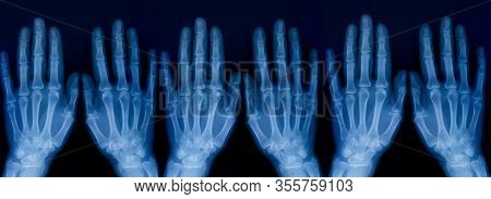 Set Of X-ray Plate Of The Bones Of The Both Human Hands