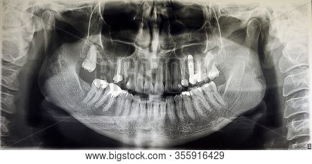 Dental X-ray Of An Adult Patient, Modern Digital Radiology For Dentistry