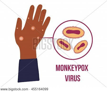 Black African Hand With Many Papule Because Of Monkey Pox Virus Outbreak Pandemic. Virion Cell Diagr
