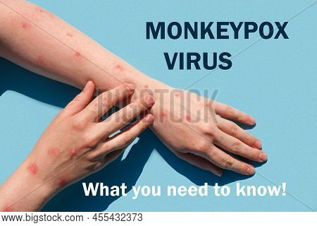 Phrase Monkeypox Virus What You Need To Know. Monkeypox New Disease Dangerous Over The World. Patien