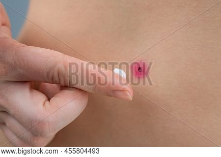 A Woman Smears Cream On A Wound After Burning A Wart.