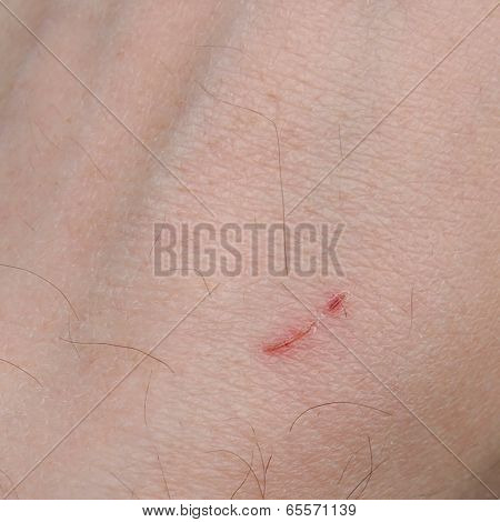 Hand Scar