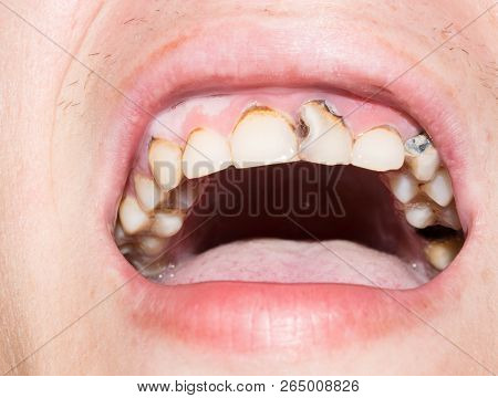 Teeth Of An Adult Person Damaged With Caries Paradontosis Disease For Medicine Design