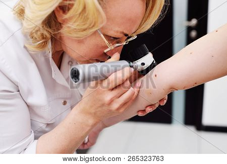 Melanoma Diagnoinspectionsis. The Doctor Examines The Patient's Mole