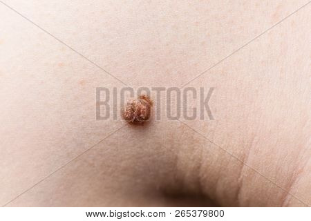 Unrecognizable Person Having Dark Fibroma, Dermatology Problem On Skin. Close Up Of Papilloma Dermat