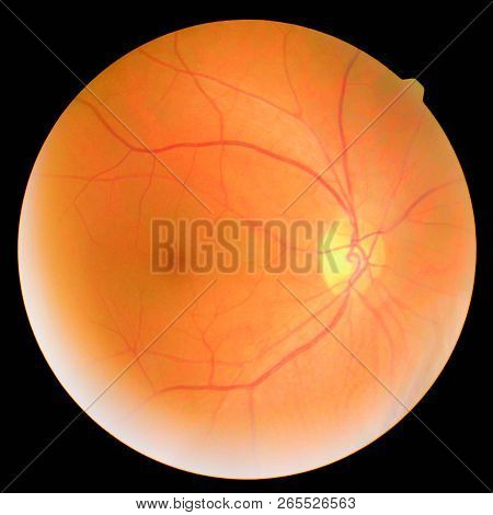 The Image Of The Retina, Retinal Photography Machine To Find Diabetic Eye Upward.