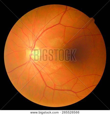 The Image Of The Retina, Retinal Photography Machine To Find Diabetic Eye Upward.