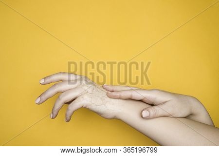 Hands With Dry Cracked Skin, The Concept Of Hand Skin Problems. Yellow Background