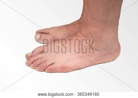 Varus Valgus And Hallux Valgus, Bunion On White Background.