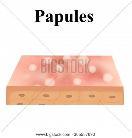 Papules. Acne On The Skin. Dermatological And Cosmetic Diseases On The Skin Of The Face Acne. Infogr