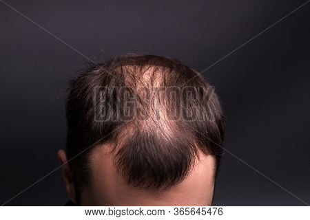 Male Head Close-up With Baldness. Studio Black Background.