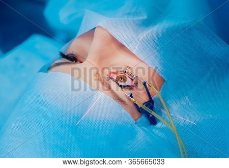 Laser Vision Correction. A Patient And Team Of Surgeons In The Operating Room