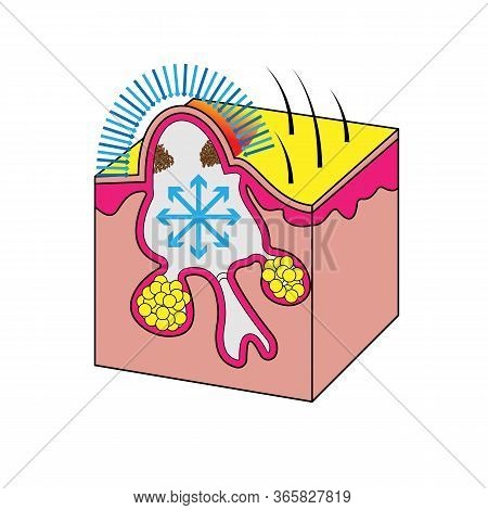 Formation Of Acne Papule And Pimples, Medical Vector Illustration