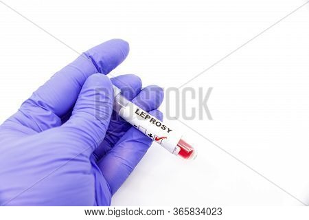 Closeup Of Microbiologist Or Medical Worker Hand With Blue Surgical Gloves Marking Blood Test Result