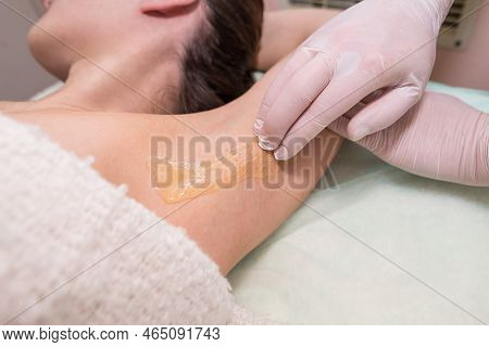 Cosmetology Sugar Hair Removal Of A Female Armpit In A Spa Center. Sugaring: Epilation With Liquid S