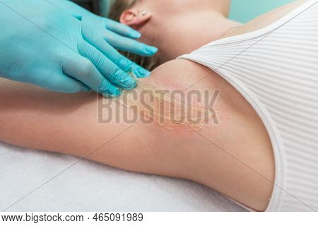 Depilation And Epilation Of The Female Armpit With Liquid Sugar Paste. The Beautician's Hand Applies